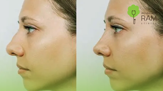 افضل-دكتور-تجميل-الانف-اللحمي